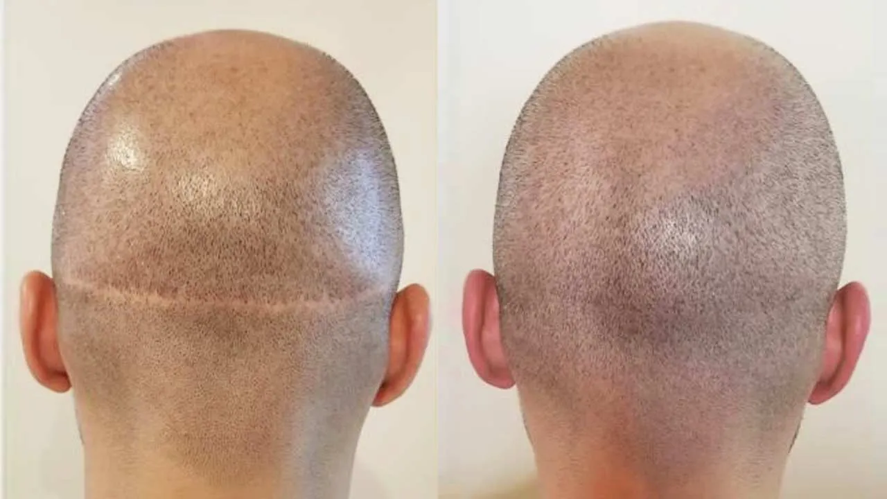 san antonio scalp micropigmentation