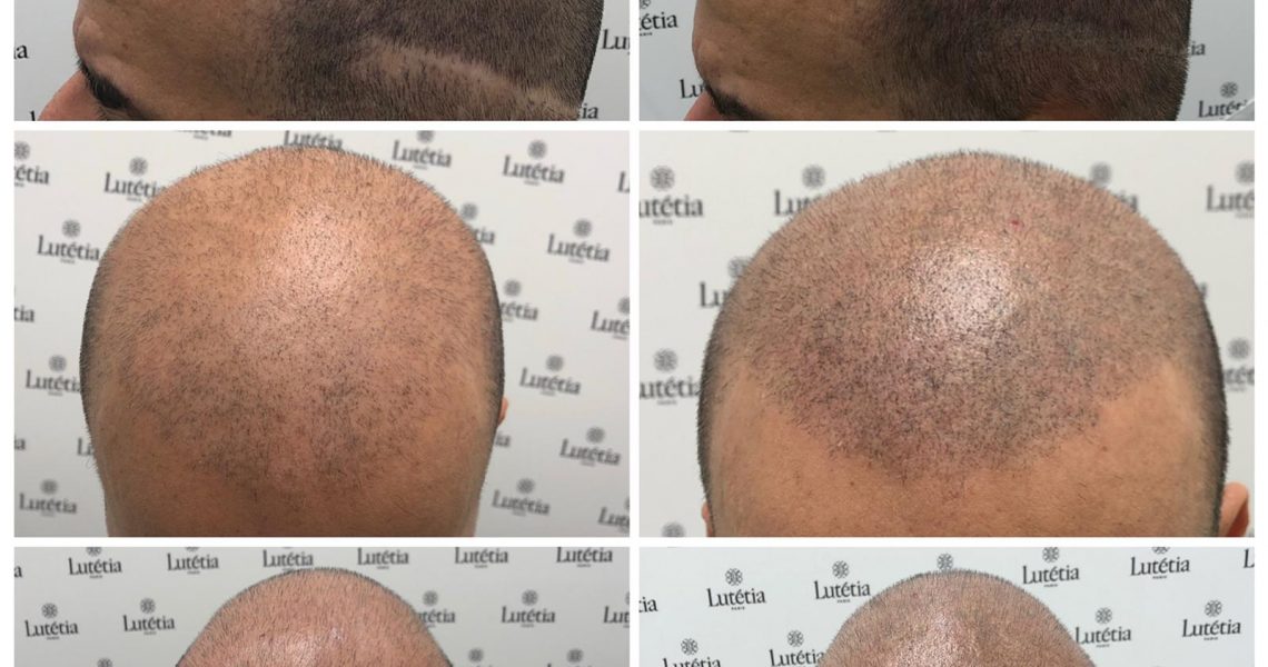 Things To Know Before Doing A Scalp Micropigmentation Treatment