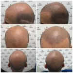 Things To Know Before Doing A Scalp Micropigmentation Treatment