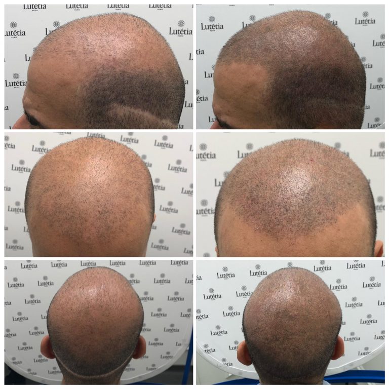 Things To Know Before Doing A Scalp Micropigmentation Treatment